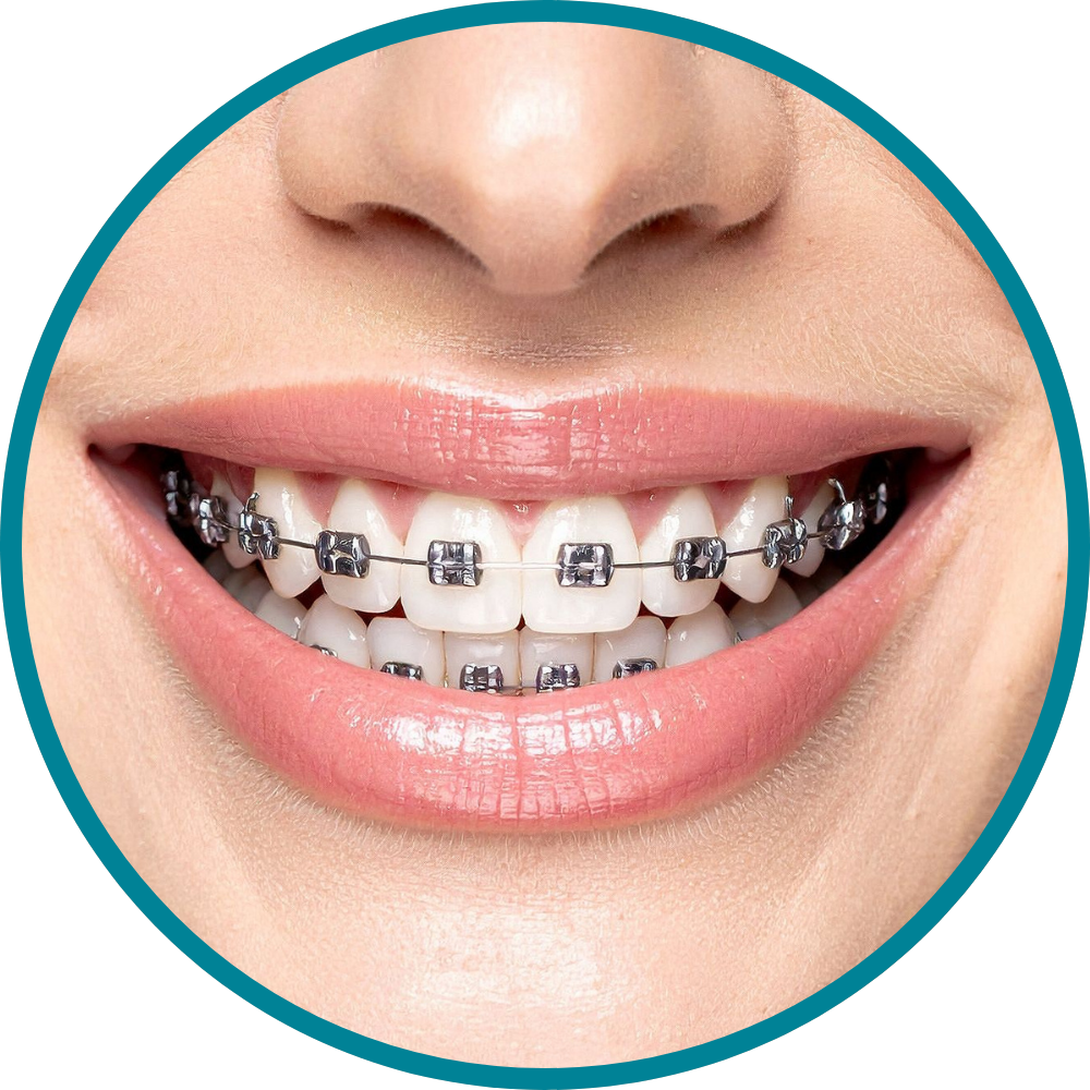 Corrección de alineación dental