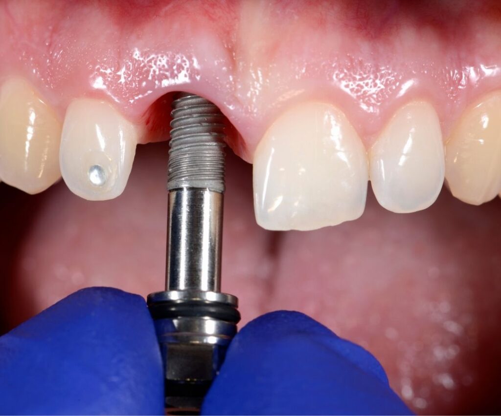 Implantes Dentales