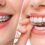 Comparación Invisalign vs brackets en Tijuana: primer plano de sonrisa con brackets metálicos y sonrisa con alineador transparente