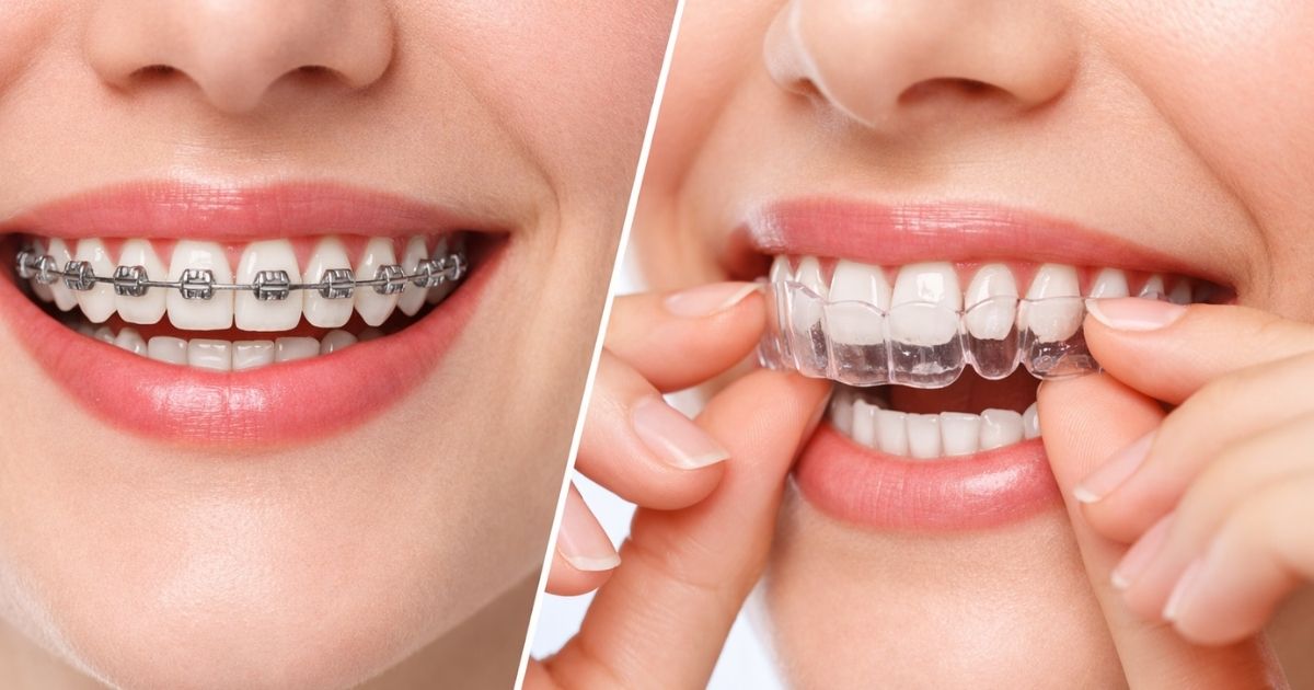 Comparación Invisalign vs brackets en Tijuana: primer plano de sonrisa con brackets metálicos y sonrisa con alineador transparente