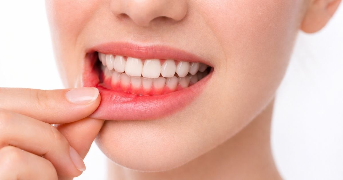 Encías inflamadas y sangrantes al cepillarse: primer plano que muestra señales de gingivitis en Tijuana